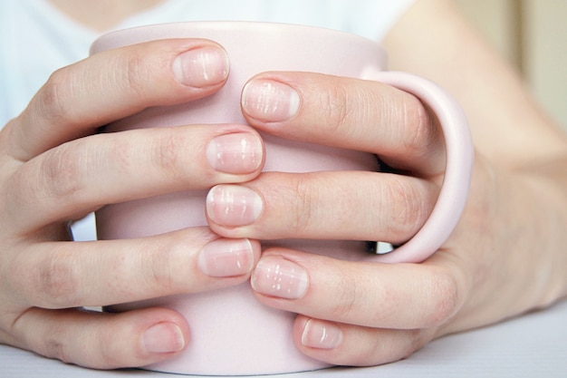 Foto manchas brancas nas unhas, leuconíquia