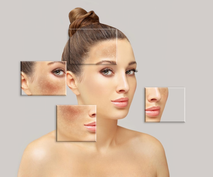 Foto manchas escuras hiperpigmentação melasma ou conceito de cloasma clareamento da pele