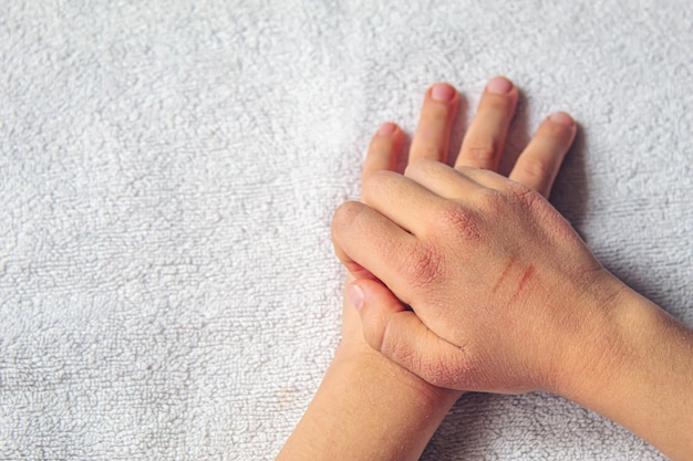 Manchas vermelhas na pele das mãos da criançafoco seletivonatureza da alergia das crianças