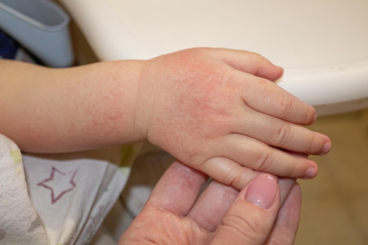 Foto manchas vermelhas na pele das mãos de uma criança alergia infantil secura e irritação da pele