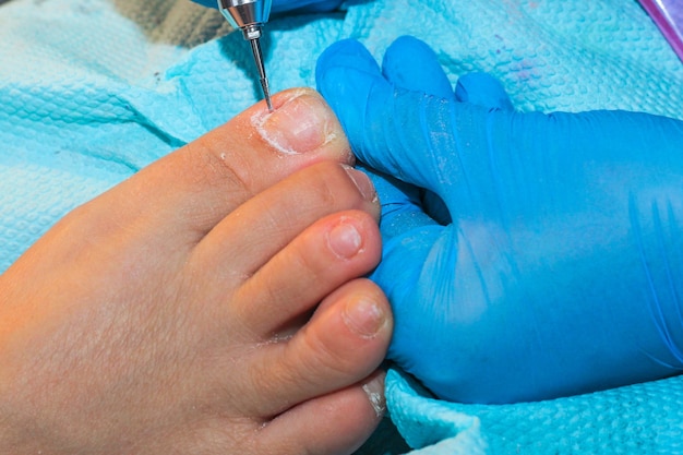 Foto un manipulador con guantes prepara la placa de la uña del dedo del pie para el recubrimiento de gel.