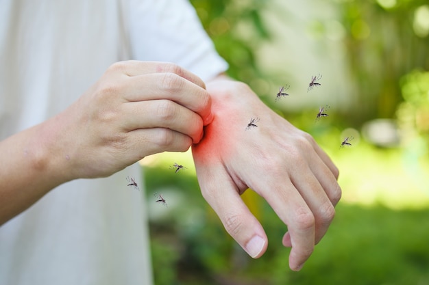 Mann Juckreiz und Kratzer auf der Hand von allergischen Hautausschlag durch Mückenstich verursacht