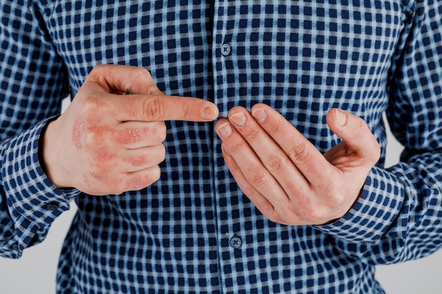 Mann mit kranken Händen trockene schuppige Haut an der Hand mit vulgärem Psoriasis-Ekzem und anderen Hautkrankheiten wie Pilzplaque-Ausschlag und Hautunreinheiten Autoimmun-Erbkrankheit