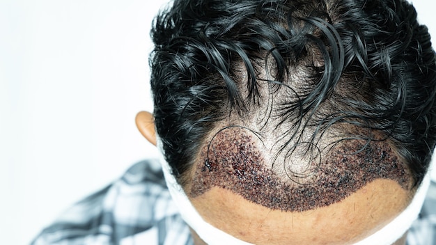Mannkopf mit Haartransplantation