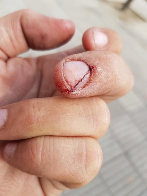 Foto mano cortada de una persona con una uña lesionada