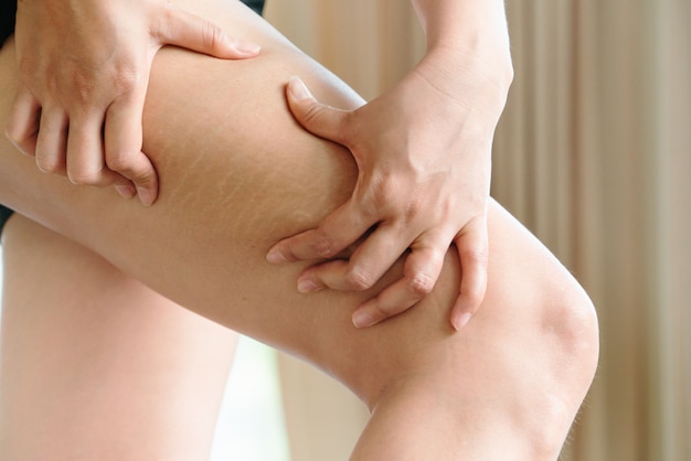 Foto mano femenina sostiene celulitis y estrías en la pierna