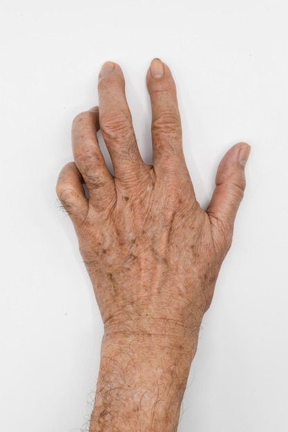 Foto mano de garra cubital del anciano asiático también conocida como 'garra de solterona