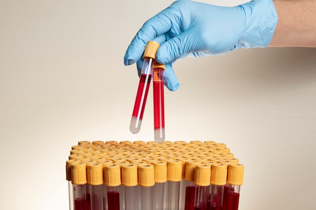 Mano con guante de nitrilo protector que sujeta el tubo para recolectar la muestra de sangre en el laboratorio.