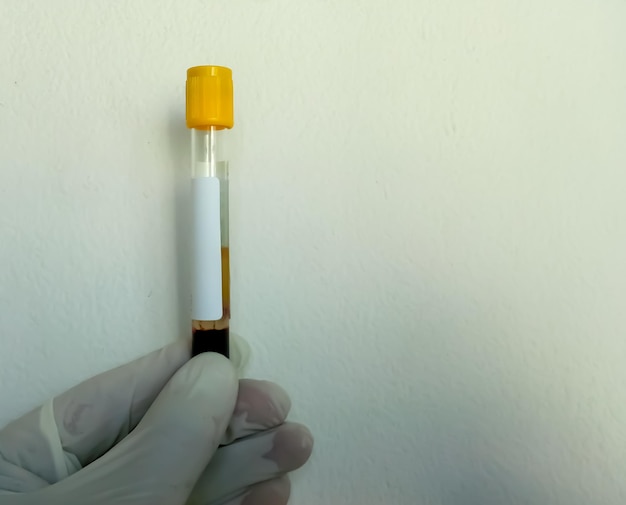 Mano del médico sostenga un tubo de muestra de sangre para análisis bioquímico con espacio de copia