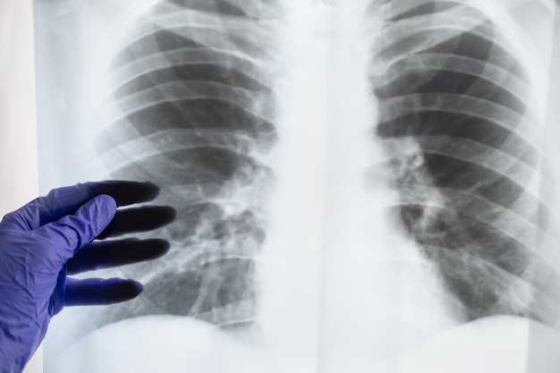 La mano del médico sosteniendo una radiografía de pulmones humanos.