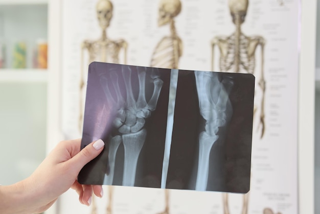 Foto mano de mujer sosteniendo radiografía de muñeca contra esqueletos en chequeo profesional de consultorio médico de