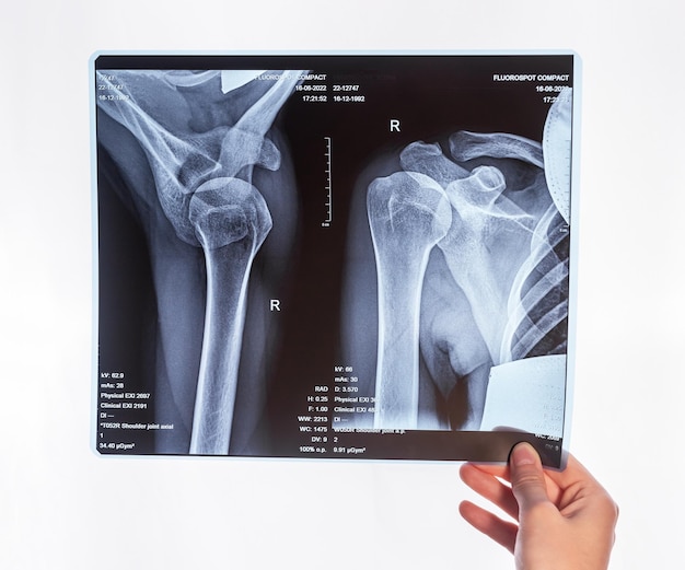 Foto mano sosteniendo hombro clavícula imagen de rayos x acromion fractura del extremo acromial lesión en el brazo cuidado de la salud concepto de imagen médica radiografía