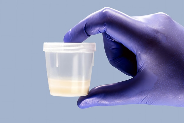 Foto mano usando guante de nitrilo con semen o contenedor de recolección de muestras de esperma concepto de donación de semen