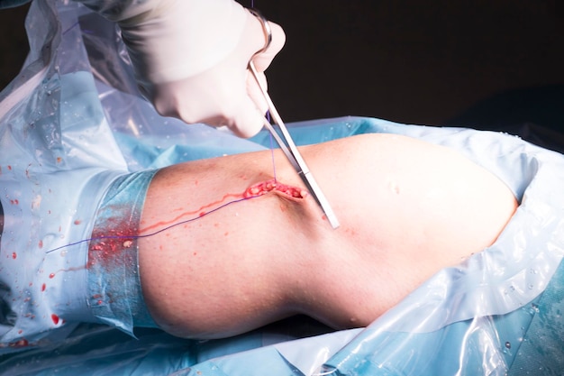 Foto manos cortadas de un cirujano que realiza una cirugía en un paciente
