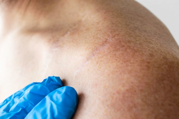 Foto las manos de los médicos en guantes de látex azul examinan la cicatriz en la clavícula.