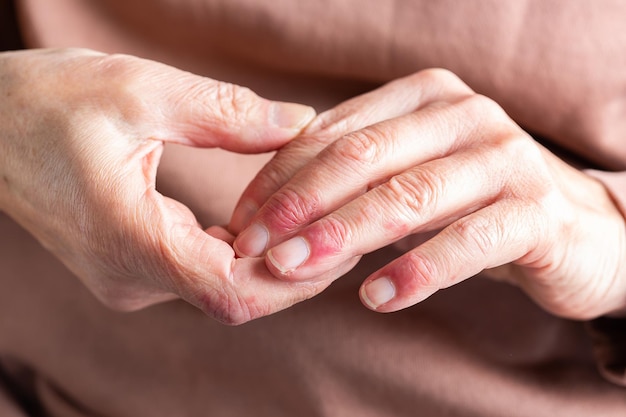 Foto manos de mujer con dermatitis atópica eccema reacción alérgica en la piel