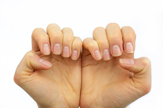 Manos de una niña con uñas blancas. falta de vitaminas salud de las uñas