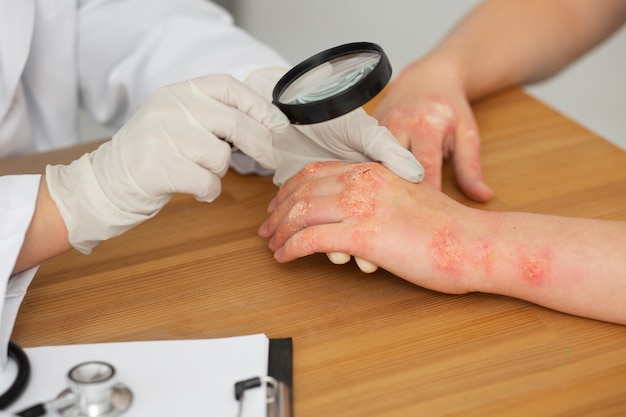 Manos del paciente que sufre de psoriasis