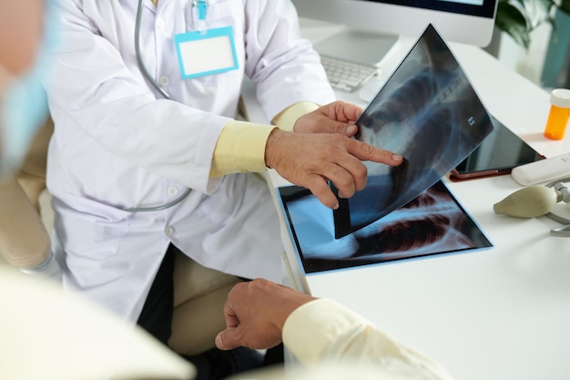 Manos de plmonologis apuntando a las radiografías de los pulmones al explicar al paciente que tiene un tumor