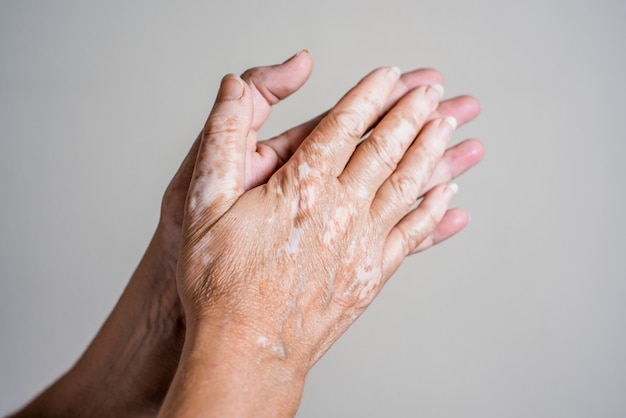 Manos con problema de piel de vitiligo
