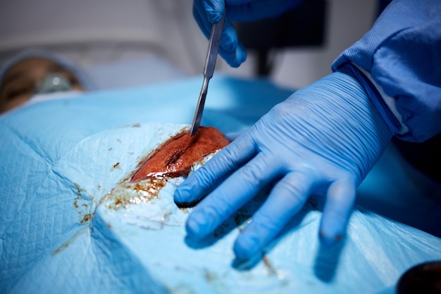 Manos de sangre o médicos cortando en cirugía o procedimiento de emergencia u operación de atención médica en el hospital Herramientas de seguridad médica con cuchillo o primer plano de cirujano en guantes ayudando en quirófano en clínica