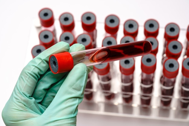 Foto manos de un técnico de laboratorio con un tubo de ensayo de muestra de sangre y una rejilla con otras muestras en blanco