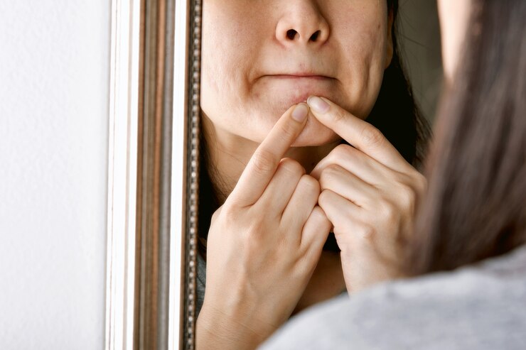 Mão de mulher de acne e pele prona apertando sua acne.