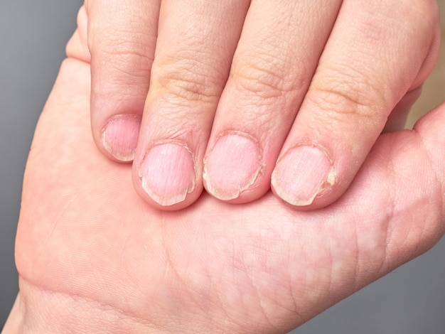 Mão de um menino de 9 anos mostrando suas unhas com unhas quebradiças ou muito fracas olhar de perto