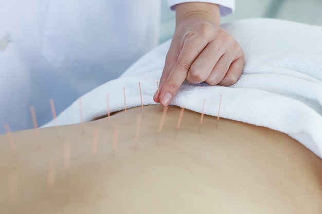 Mão do médico realizando terapia de acupuntura. Mulher asiática em tratamento de acupuntura com uma linha de agulhas finas inseridas na pele do corpo no hospital clínico