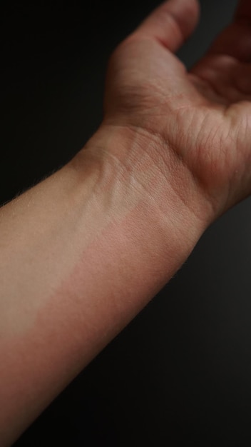 Mão feminina coberta com manchas vermelhas, close-up. Reação alérgica a um antibiótico. Mão no fundo preto - foto vertical