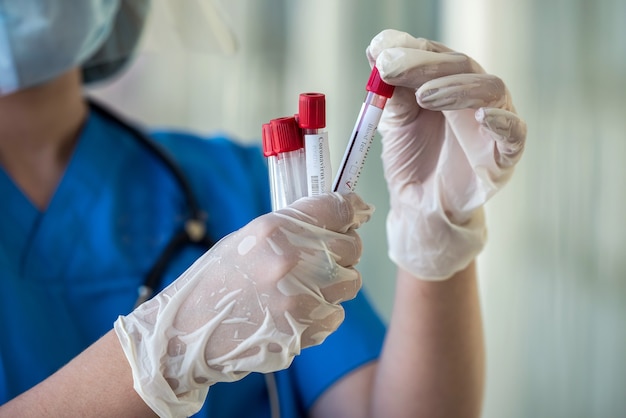 Mão feminina segurando o tubo de ensaio com corona covid19 marcada com sangue positivo. Ciência