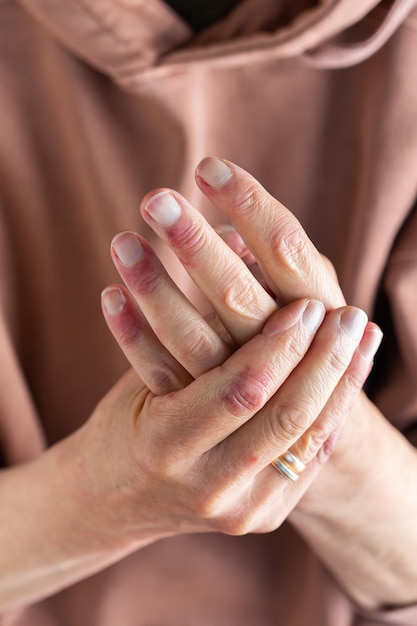 Mãos de mulher com reação de alergia de eczema de dermatite atópica na pele