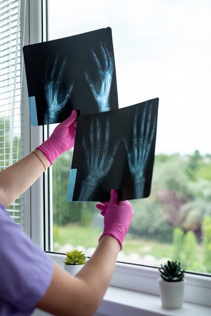 Mãos do médico segurando imagens de radiografia de raios-X na clínica Cirurgião médico revisando a varredura dos ossos do paciente Resultado do teste de triagem Exame médico Conceito de radiologia de saúde