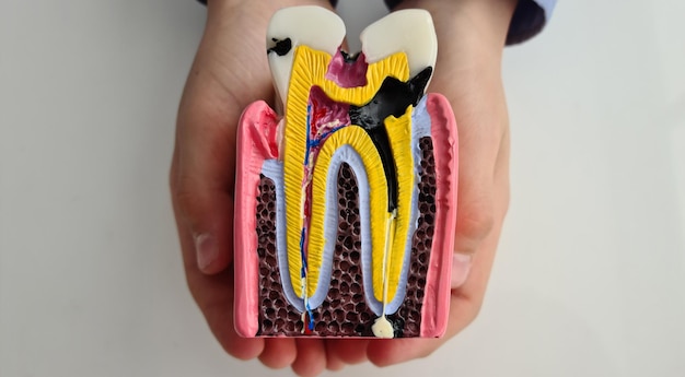 Maqueta de anatomía de sección de diente con caries en manos de niños