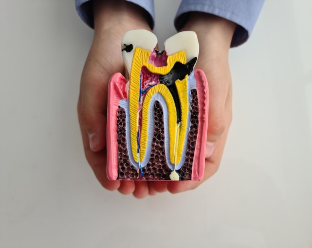 Maqueta de anatomía de sección de diente con caries en manos de niños