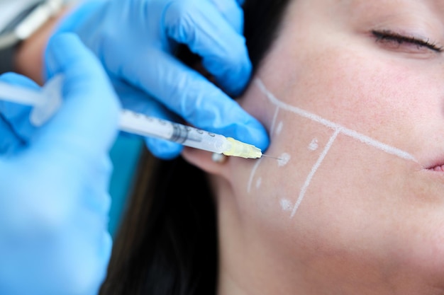 Marcação facial com lápis dermoplástico branco de pontas para tratamento de antibruxismo mandibular com toxina botulínica