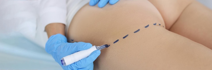 Foto marcas de dibujo del cirujano en el cuerpo femenino antes de la operación plástica