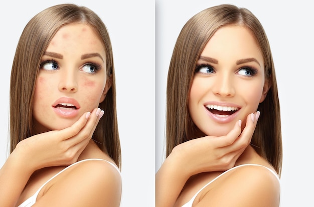 Marcas pós-acne Tratamento de cicatrizes de acne Remoção de cicatrizes de acne