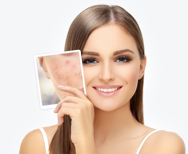 Marcas pós-acne Tratamento de cicatrizes de acne Remoção de cicatrizes de acne