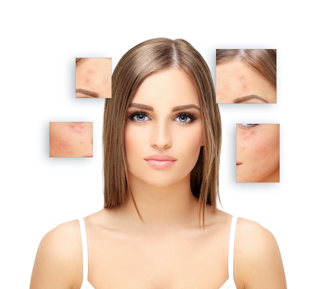 Foto marcas pós-acne tratamento de cicatrizes de acne remoção de cicatrizes de acne