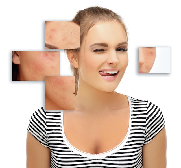 Foto marcas pós-acne tratamento de cicatrizes de acne remoção de cicatrizes de acne