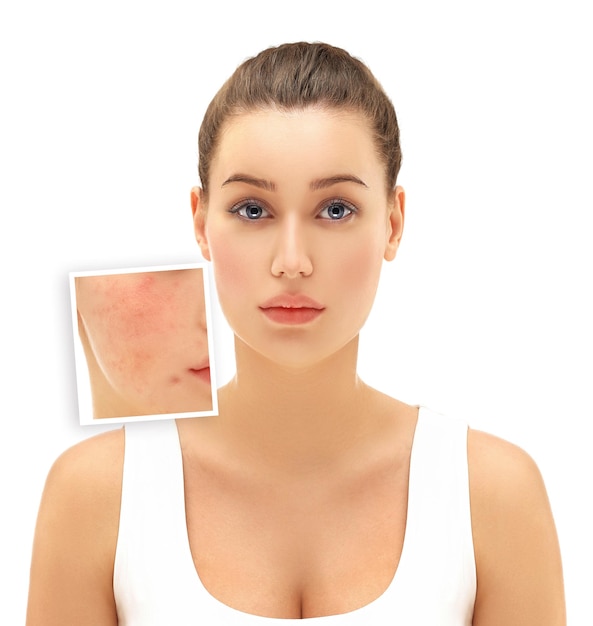 Marcas pós-acne Tratamento de cicatrizes de acne Remoção de cicatrizes de acne