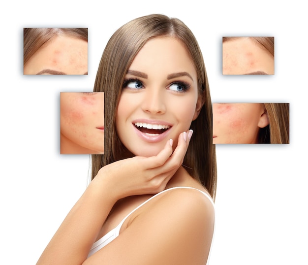 Marcas posteriores al acné Tratamiento de cicatrices de acné Eliminación de cicatrices de acné