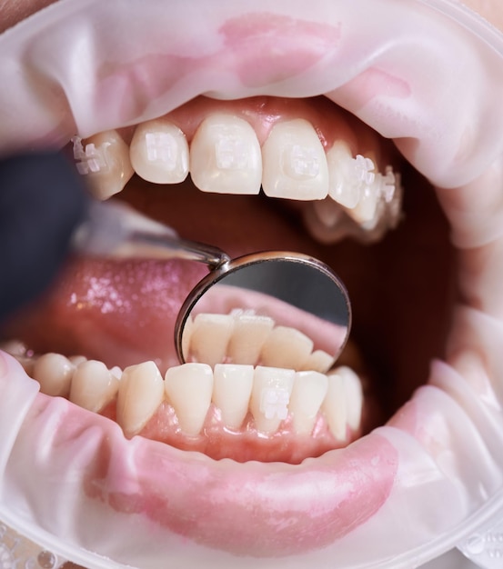 Foto marco instantánea de la mano del dentista revisando los dientes inferiores del paciente con la ayuda de un espejo vista frontal de hermosos dientes blancos con soportes de cerámica durante el procedimiento dental retractor de mejillas en los labios