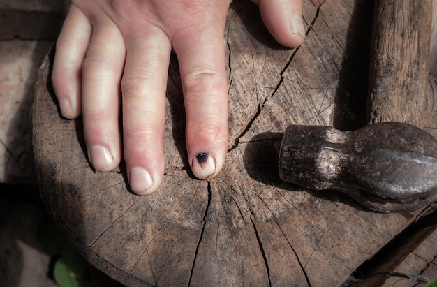 Martelo e dedo humano com unha machucada escura Lesão no dedo Hematoma preto nas unhas após martelar Trabalho perigoso