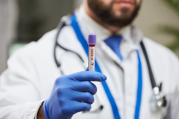 Un médico con barba que muestra una muestra de sangre de coronavirus en la mano.