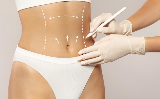 Foto médico cirurgião de beleza profissional em luvas desenha formas no corpo de uma jovem para cirurgia plástica