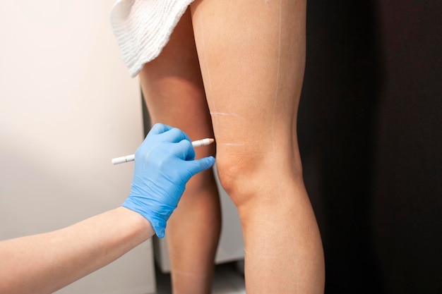Médico cosmetologista faz marcações das pernas do paciente antes do procedimento de coolsculpting