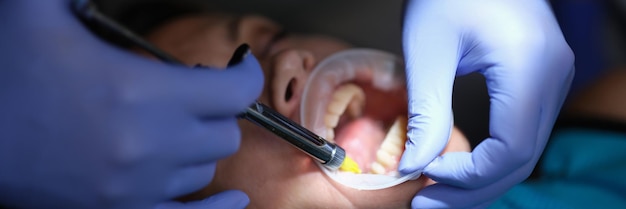 Foto médico dentista aplicando adesivo para folheados e próteses em clínica closeup