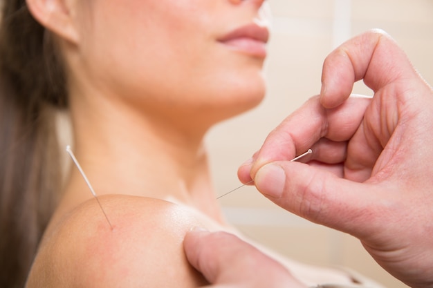 Foto médico manos aguja de acupuntura pinchando en mujer